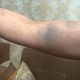 Фото Чолпон Шайылдаевой. Следы побоев